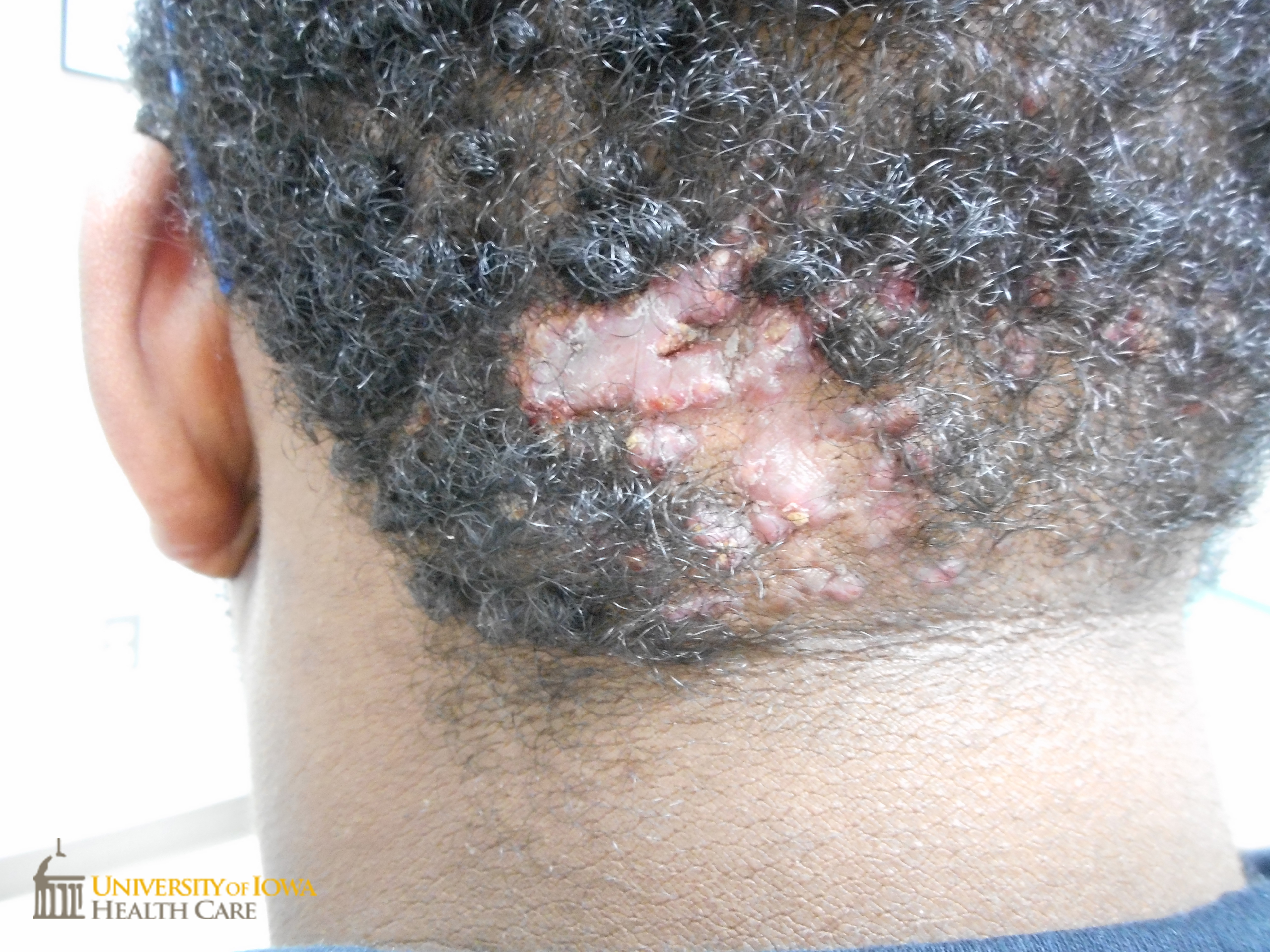 Pink keloidal plaques on the occipital scalp. (click images for higher resolution).